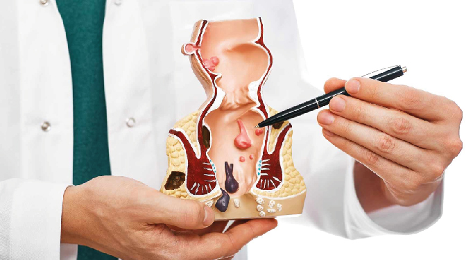 Fístulas Perianales